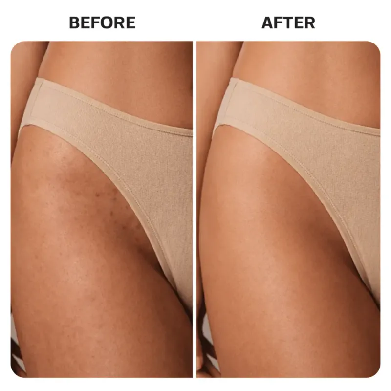 Ingrown Hair Treatment Pads